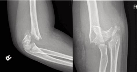 orthopedics - Supracondylar Fracture to the Humerus - Medical Sciences Stack Exchange