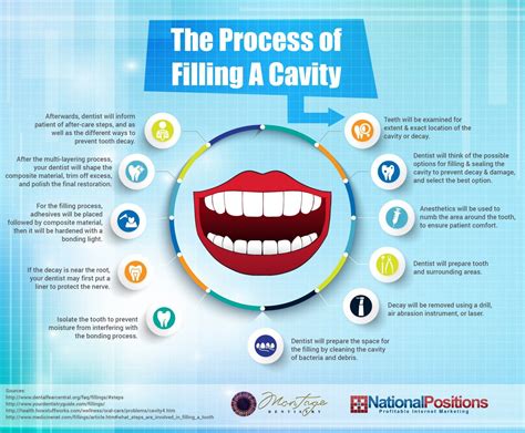 The Process of Filling a Cavity | Visual.ly | Cavities, Dental implants, Cavity filling