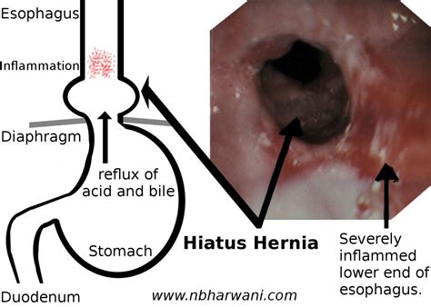 What are the Long Term Consequences of Untreated Heartburn? – Dr ...