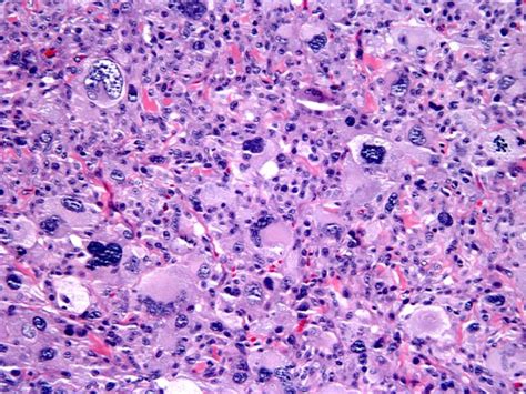 Atypical fibroxanthoma (pseudocarcinoma, fibrosarcoma, paradoxical fibrosarcoma ...