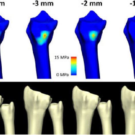 Location of contact on radial sigmoid notch for up to 5 mm of ulnar... | Download Scientific Diagram