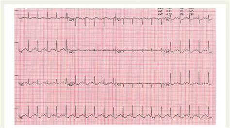 Electrocardiogram performed when patient developed angina during the... | Download Scientific ...