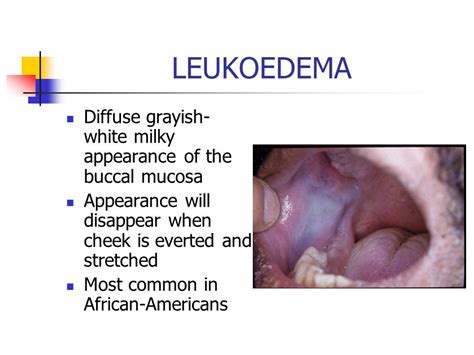 Leukoedema