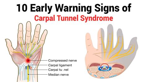 Carpal tunnel syndrome - lomiqq