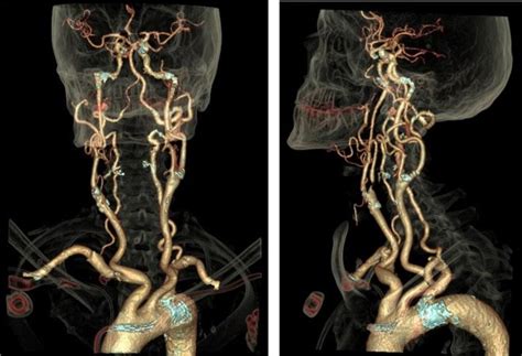 CT Scan or Angiogram - What is the Difference?