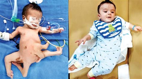 15-day-old Iraqi child with 8 limbs successfully operated by Noida doctors