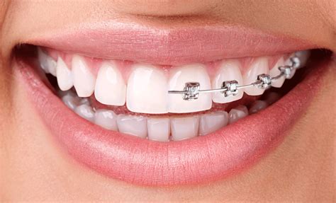 Braces & Invisalign | Dental Laser Esthetics