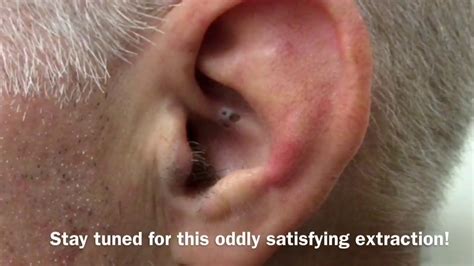 Ear Blackhead Extraction | Dr Steven Greene in Seattle - YouTube