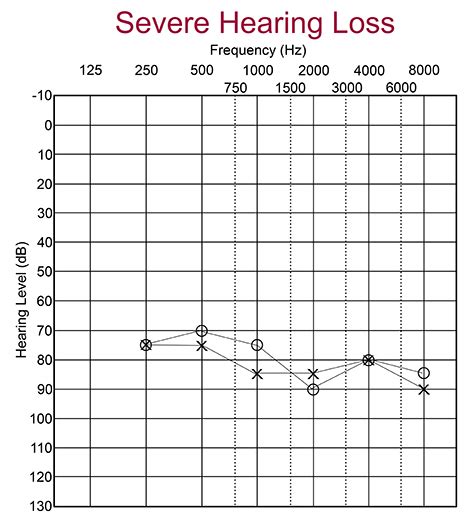 How To Read An Audiogram: Essential Types And Symbols, 56% OFF