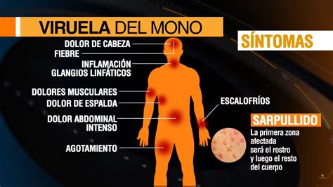 Estos son los síntomas que genera la viruela del mono en humanos