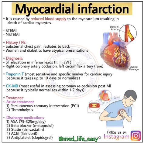 Myocardial infarction - MEDizzy