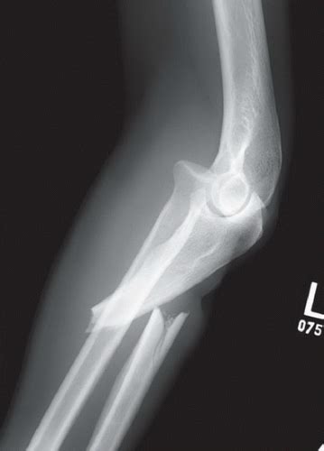 Monteggia Fracture | Radiology Key