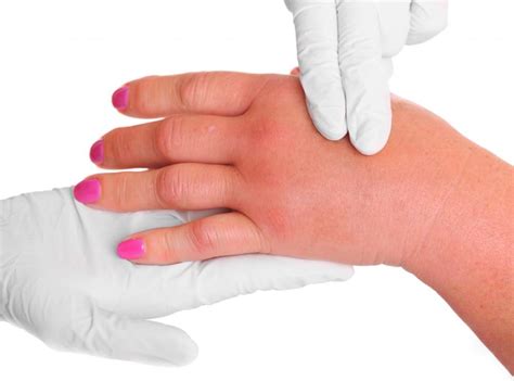 What Are the Common Causes of Swollen Fingers? (with pictures)