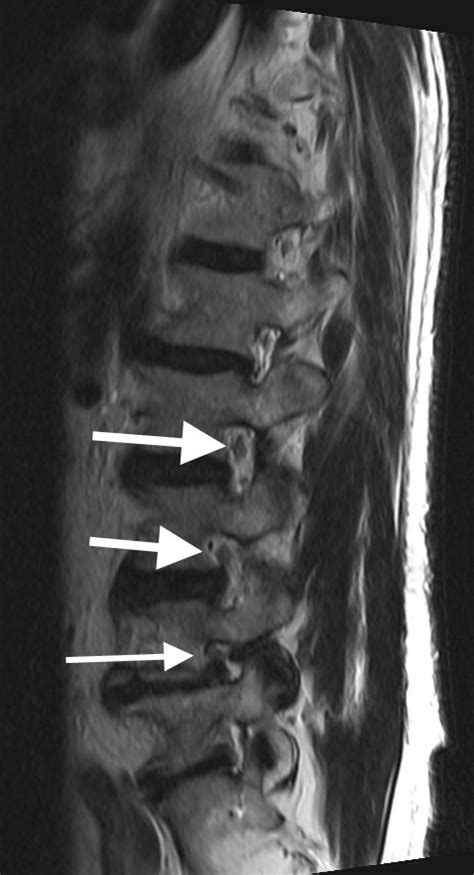 Foraminal Stenosis Mri