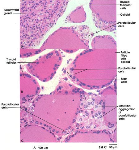 Medullary Thyroid Carcinoma