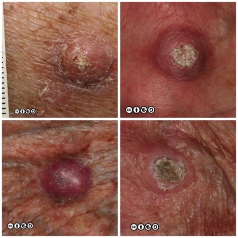 Squamous cell carcinoma - Skin Cancer 909