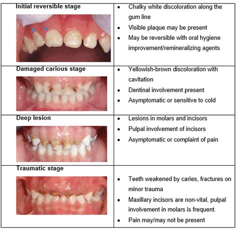 Early Childhood Caries - Essential Information for Primary Healthcare Providers || Oral Health ...