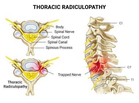 Thoracic Radiculopathy NJ & NYC