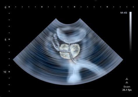 Hypertrophie prostatique : le volume normal de la prostate