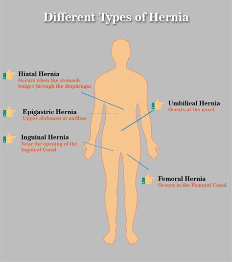 Laparoscopic Hernia Surgery - Keyhole Hernia Repair