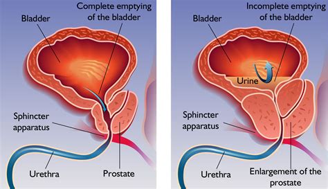 Symptoms and treatment of prostate enlargement - Mysurgeryabroad - Medicover Hospital - Hospital ...