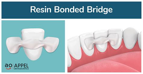 Missing Lateral Incisors? Braces Can Help! - Philadelphia