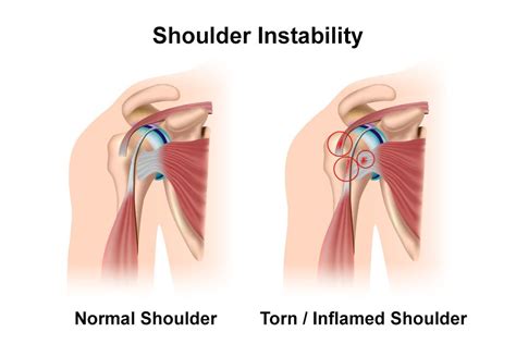 Shoulder Reconstruction - Austin, TX - Cedar Park, TX - Orthopaedics