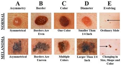 Early signs of Skin Cancer | Skin We Are In