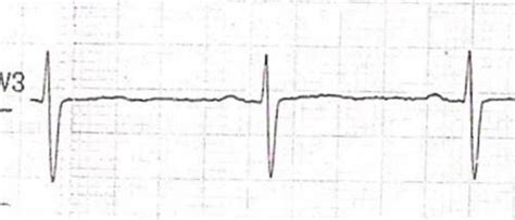 flat t wave | Dr.S.Venkatesan MD