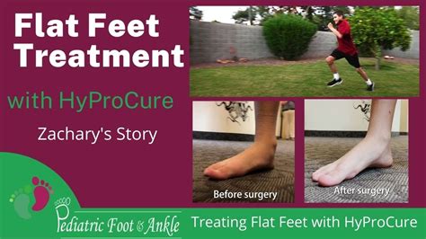 Treatment For Flat Feet And Fallen Arches Discount | www.medialit.org