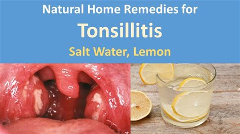 Natural Home Remedies for Tonsillitis|Salt Water, Lemon - YouTube