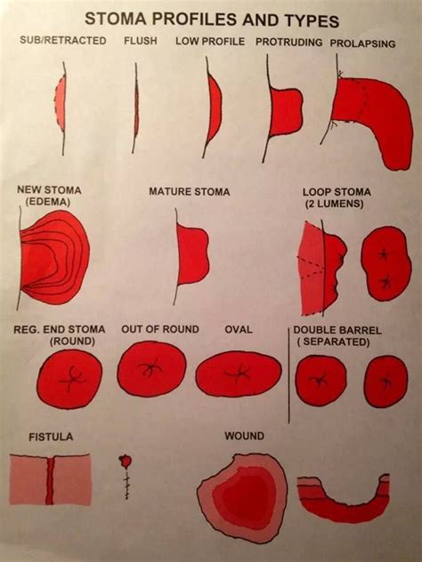 Stoma Types | nursing | Wounds nursing, Nursing board