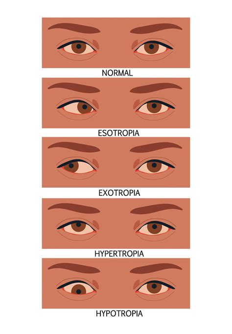 Vision Therapy & Treatment for Strabismus | Microprism Vision