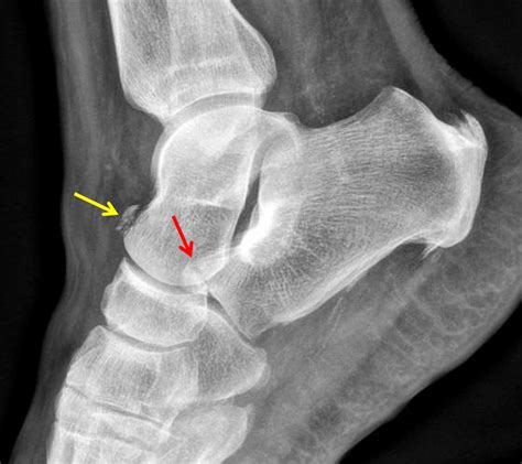 Calcaneal