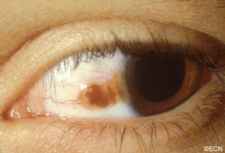 Pigmented Conjunctival Cancers (Primary Acquired Melanosis) » New York ...