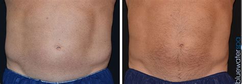 CoolSculpting® for Men