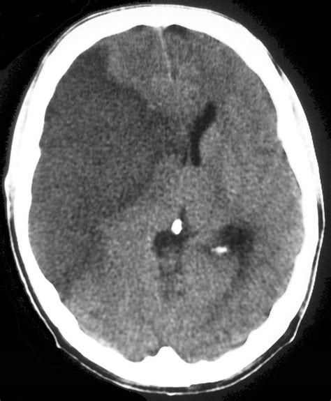 Acute infarct - Radiology at St. Vincent's University Hospital