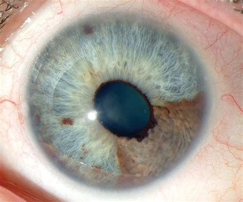 Ocular Melanoma Pictures – 27 Photos & Images / illnessee.com