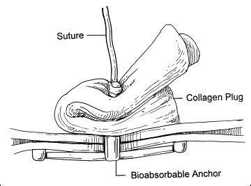 Angio-Seal Complications submited images.