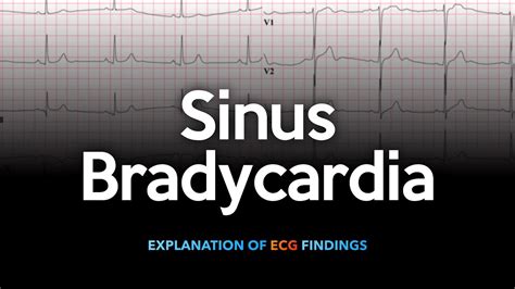 Sinus Bradycardia ECG - YouTube