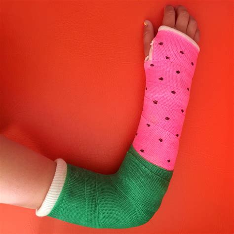 Best colour for an arm cast 'watermelon' Alex Fulton Design Instagram ...