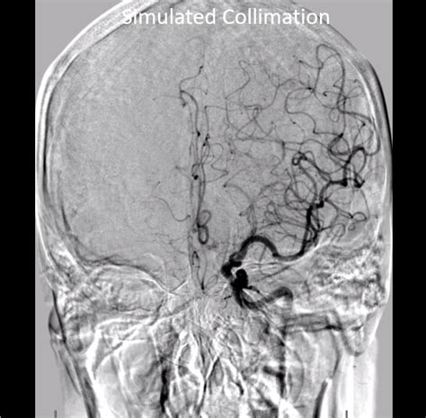 The Art of Cerebral Angiography | neuroangio.org