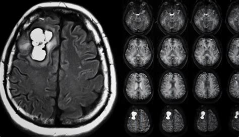 Glioblastoma Multiforme - Symptoms, diagnosis and treatment