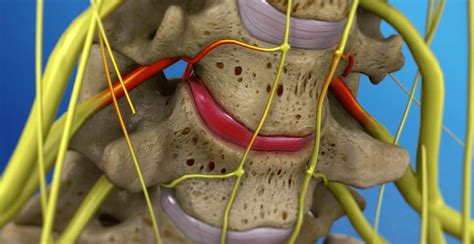 Compressed Nerve - Similiar name for Radiculopathy