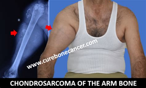 CHONDROSARCOMA