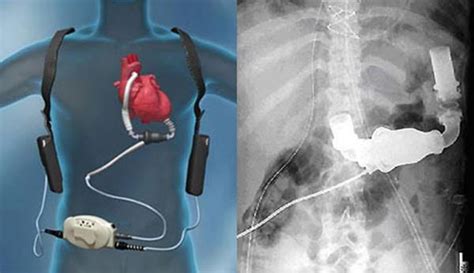 Multi-institutional study finds increased thrombosis in HeartMate II ...