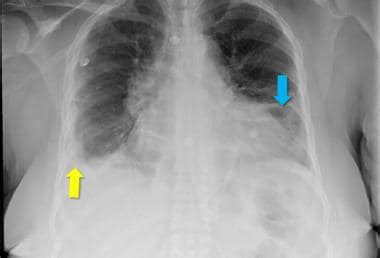 Systemic Lupus Erythematosus (SLE) Workup: Approach Considerations, Diagnostic Studies ...