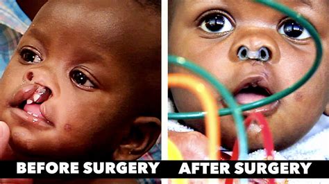 BEFORE & AFTER CLEFT LIP / CLEFT PALATE SURGERY | Dr. Paul - YouTube