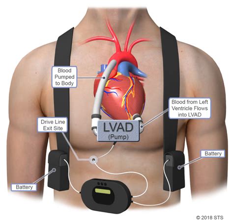 Left Ventricular Assist Device - Newport Cardiac & Thoracic Surgery