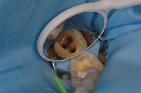 Top tips on endodontics - Dentistry.co.uk